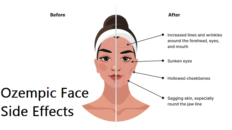 Ozempic Face Side Effects What You Need To Know