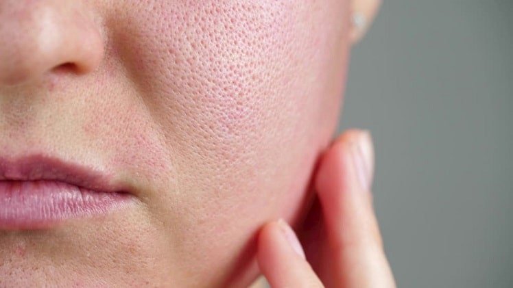 Clogged Pores A Thing of the Past